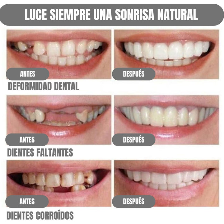 DentalGlow® Carillas Dentales para una Sonrisa Natural