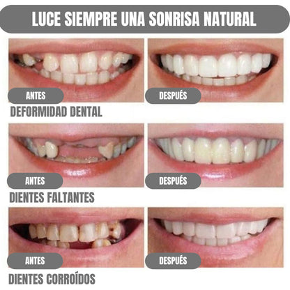 DentalGlow® Carillas Dentales para una Sonrisa Natural